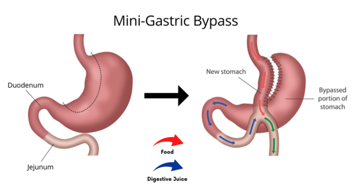 mini gastric bypass procedure in istanbul turkey