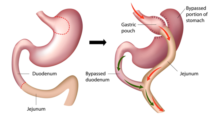 roux y gastric bypass in istanbul turkey
