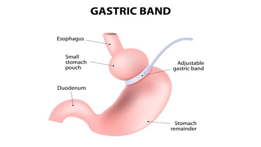 gastric band op in istanbul turkey