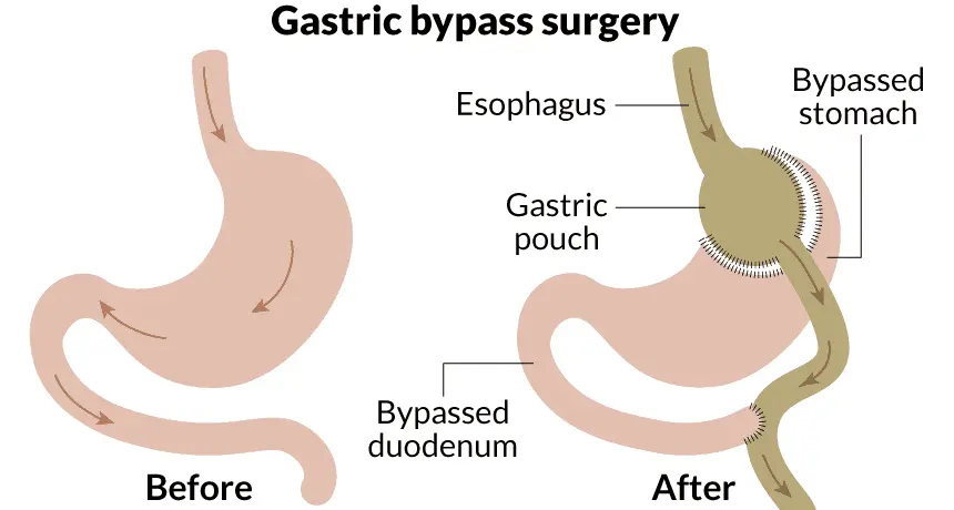 gastric bypass surgery in istanbul turkey