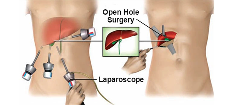 laparoscopic bariatric surgery in istanbul
