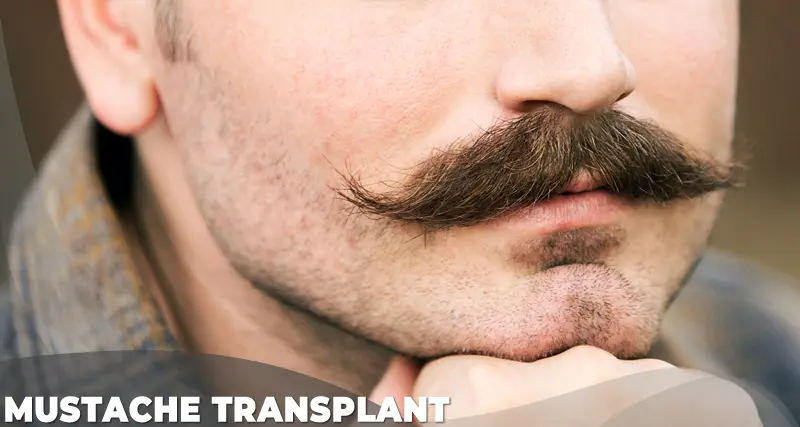 mustache transplant