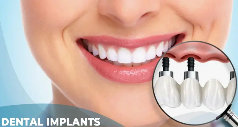 dental implants in turkey istanbul