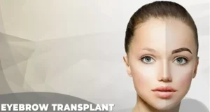 eyebrow transplant istanbul turkey
