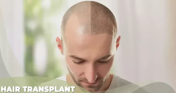 hair transplant